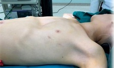 Phẫu thuật nội soi cho bệnh nhi lõm ngực bẩm sinh