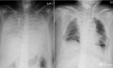 Bệnh nhân COVID-19 đầu tiên được ghép phổi từ người hiến tặng còn sống