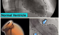 Vén tấm màn bí ẩn của hội chứng "tan vỡ trái tim"