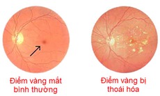 Tìm ra protein giúp điều trị bệnh thoái hóa điểm vàng