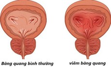 Có thể rút ngắn phác đồ kháng sinh trị viêm bàng quang cấp ở phụ nữ