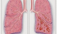 Cảnh báo xơ phổi – di chứng của COVID-19