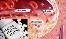 Statin có liên quan đến giảm nguy cơ ung thư đại trực tràng