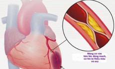 Ngay cả liều thấp steroid cũng có thể làm tăng nguy cơ mắc bệnh tim