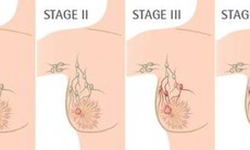 Phối hợp phẫu thuật và xạ trị cho bệnh nhân ung thư biểu mô tuyến vú không xâm lấn