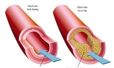 Phát hiện protein có vai trò quan trọng trong chứng xơ vữa động mạch