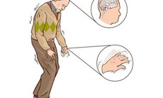 Liệu pháp mới giúp cải thiện chất lượng sống cho bệnh nhân Parkinson