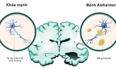 Nghiên cứu vắc-xin chống lại bệnh Alzheimer