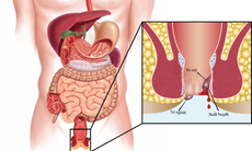 Dùng thuốc chữa bệnh trĩ như thế nào cho hiệu quả?