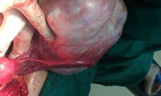 BV E bóc tách thành công khối u nhầy buồng trứng khổng lồ nặng 1,8 kg 