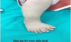 Cần làm gì khi trẻ bị dị tật thừa ngón chân ?