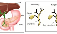 Cần phát hiện sớm u nang ống mật chủ