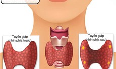 Nguyên nhân nào gây suy giáp ở trẻ em?