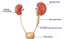 Điều trị hẹp niệu quản với “vũ khí” mới