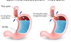 Cải thiện trào ngược dạ dày – thực quản