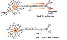 Phòng viêm đa rễ thần kinh