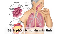 Phòng ngừa nguy cơ cho người bệnh phổi tắc nghẽn mạn tính trong đại dịch