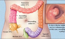 Phát hiện sớm ung thư đại trực tràng