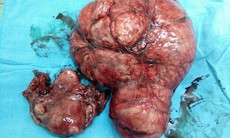 Cần Thơ: Phẫu thuật khối u xơ tử cung 3kg cắm giữa bàng quang và âm đạo