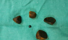 Phẫu thuật cấp cứu bệnh nhân tắc mật hoàn toàn do sỏi ống mật chủ