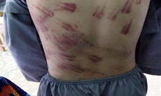 Sự thật bé trai nghi bị sư thầy bạo hành với nhiều vết thâm