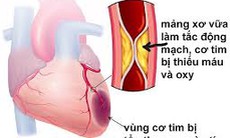 Từ vụ bệnh nhân sau phẫu thuật ruột thừa rồi tử vong, cảnh báo căn bệnh không chừa một ai