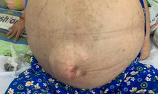 Rút hơn 40 lít nước trong bụng cứu cô gái "cõng" khối u khổng lồ, y văn thế giới  mới ghi nhận 10 ca