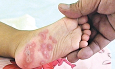 Bệnh tay chân miệng gia tăng ở Đồng Nai, 6 quy tắc phòng bệnh cần nhớ