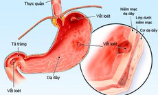 Đau dạ dày do thuốc?