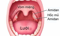 3 vấn đề quan trọng người bị viêm amidan cần biết !