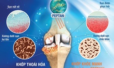 Tổn thương xương dưới sụn - nhận diện mới của thoái hóa khớp