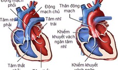 Tầm soát bệnh tim bẩm sinh nặng ở trẻ sơ sinh