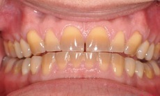 Tôi làm sẫm màu răng của người dùng