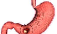 Viêm loét dạ dày - tá tràng do đâu?