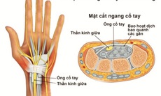 Hội chứng ống cổ tay