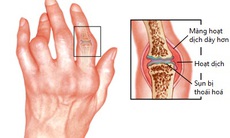 Hạn chế biến chứng do viêm đa khớp