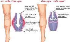 Ứng dụng laser điều trị suy tĩnh mạch chi dưới mạn tính