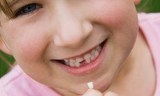 Làm gì khi bé 2 tuổi bị gãy răng cửa, sưng nướu?