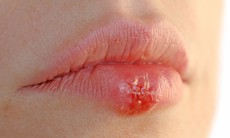 Bệnh do herpes và dùng  thuốc