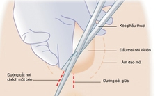 Tại sao phải cắt tầng sinh môn khi sinh con