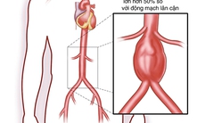 Phình động mạch chủ bụng