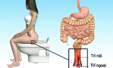 Thập nhân cửu… trĩ