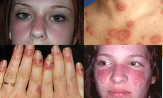 Lupus ban đỏ hệ thống và việc dùng thuốc