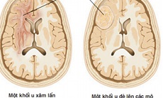 U não thường phát hiện muộn