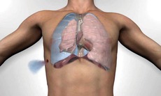 Biến chứng do tràn khí màng phổi