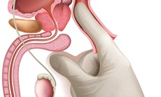 Điều trị phì đại lành tính tuyến tiền liệt