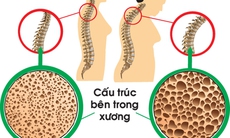 Trị bệnh xương khớp ở người cao tuổi: Các khuyến cáo mới