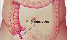 Dấu hiệu viêm ruột thừa?