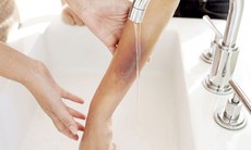 Có phòng được sẹo sau bỏng không?