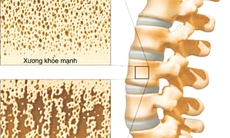 Khi nào cần đo mật độ xương?